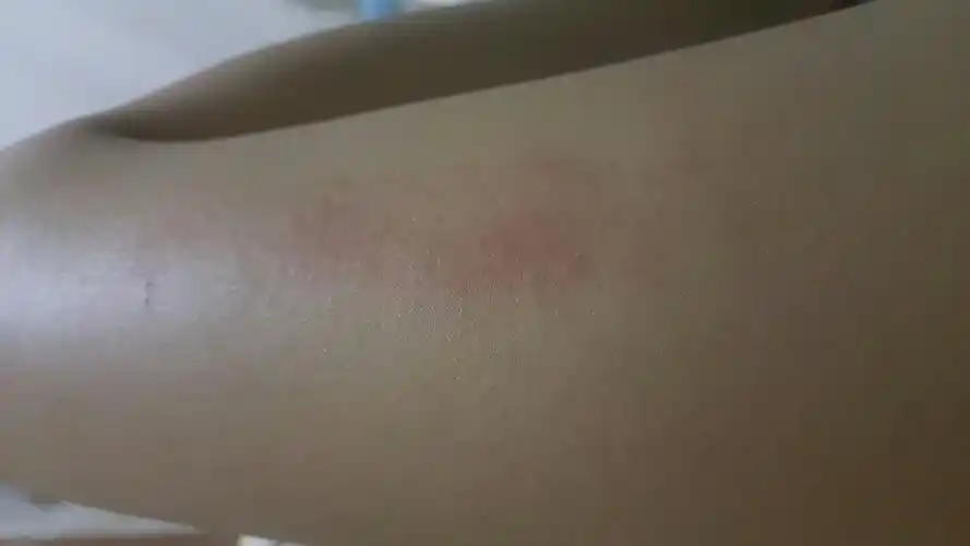 用沐浴露后腿外侧皮肤刺痛泛红