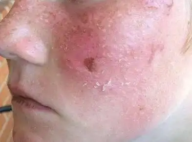 干敏肌洗脸要不要用洗面奶别傻傻以为不用否则皮肤越来越差