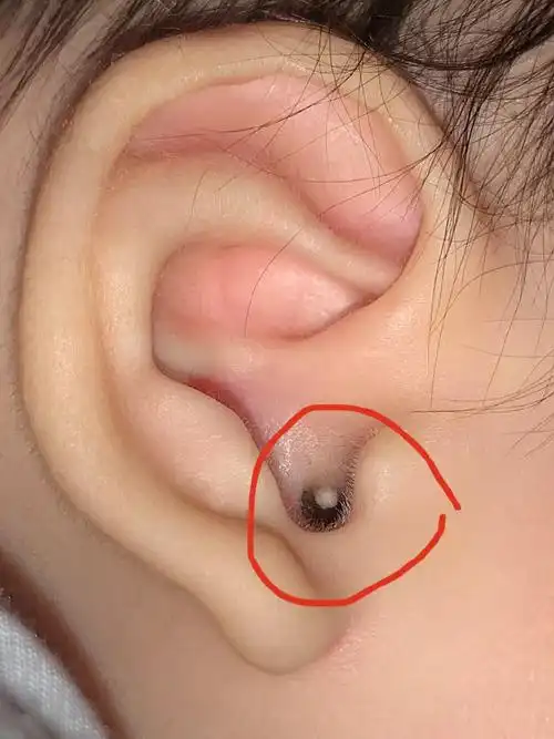 图片耳朵里长小白粒图片耳朵里面长了个小鼓包耳道内有凸起的小肉球