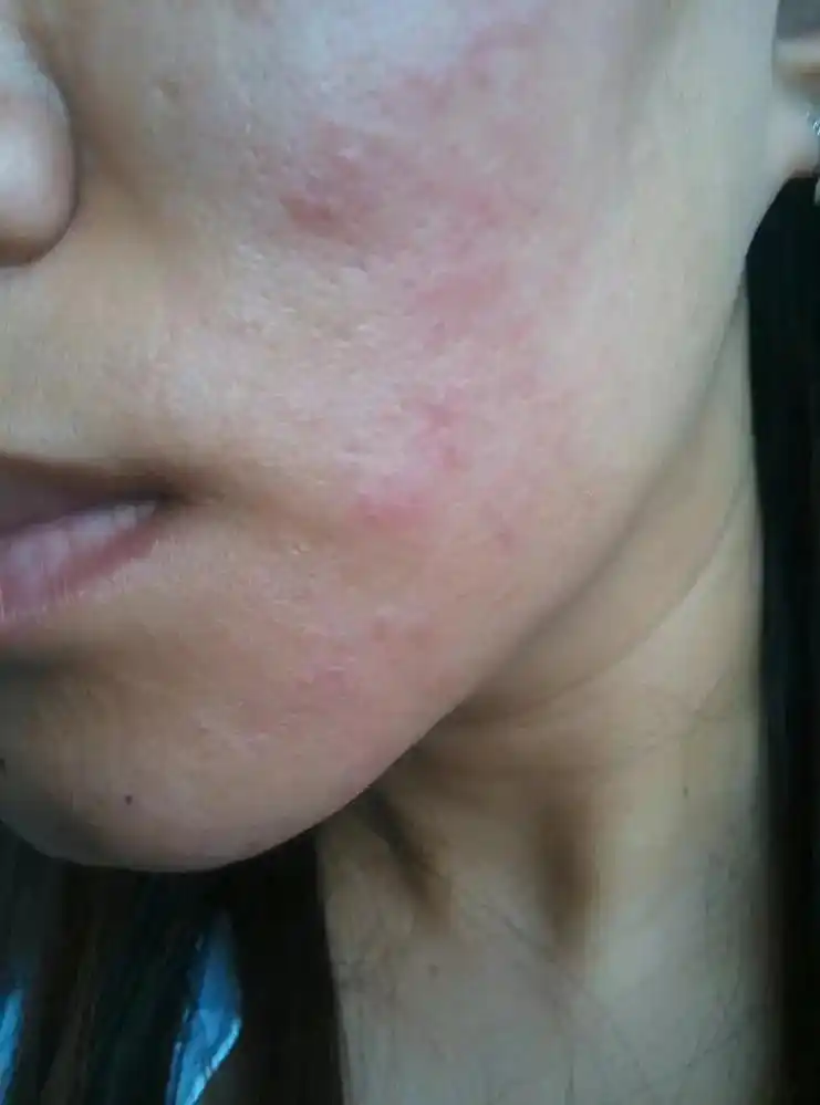 皮肤过敏的临床症状表现为皮肤变得发痒,发红,鳞片,干燥,肿胀 - 抖音