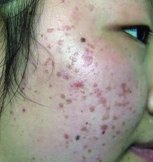 脸上扁平疣图症状图片 - 搜狗图片搜索