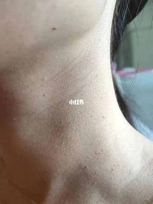 所以我现在超级的害怕,我的情况是脖子上有明显的扁平疣,而且一大片都