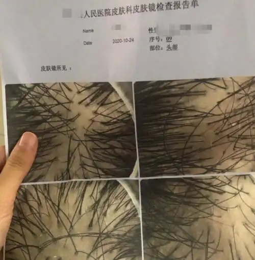 去屑止痒控油洗发水推荐缓解油头的苦恼