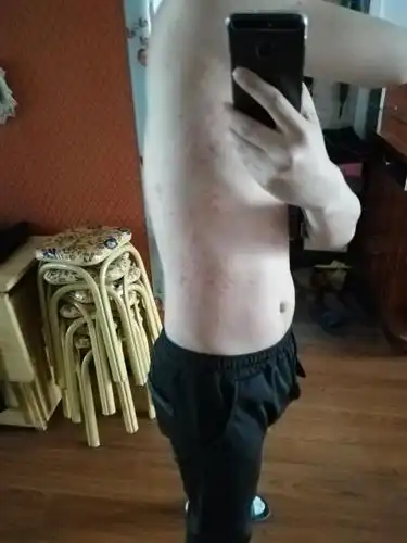 前天吃虾了可能是吃什么过敏吧超级痒现在浑身都是疙瘩