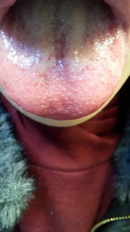 今天刷牙的时候看到舌头上长了些小红痘,求