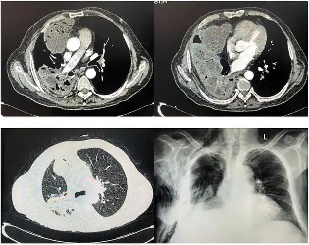 胸部,腹部ct回报:肝脏,右肺及腹腔,盆腔多发巨大囊性病灶,符合包虫病