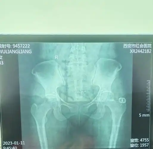 有没有会看的,第一张我感觉两个大转子,高低不一样,胯骨头突出,穿裤子