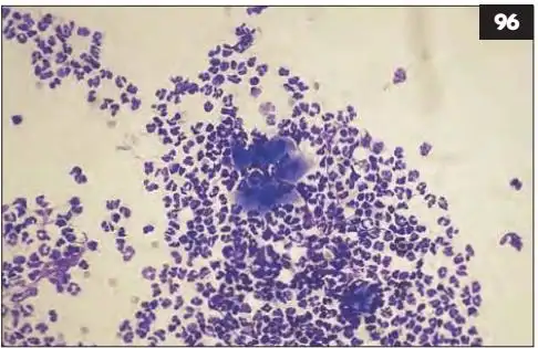 26张临床图片完整分析为你全面展示耳部细胞学检查-下