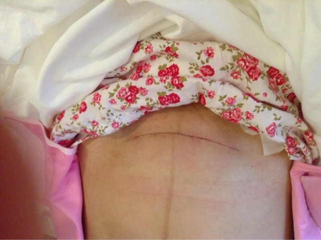 nbsp;  7个月前 我是9月20号剖的逗比宝爸  一星期伤口发炎