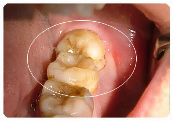 智齿是最后才生长的牙齿,当它在牙槽骨准备萌出时,却发现其他牙齿已把