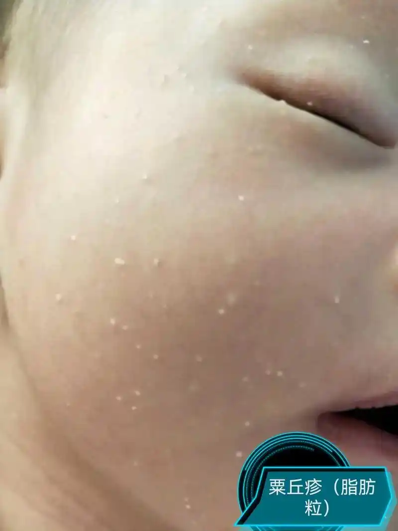 粟丘疹脂肪粒