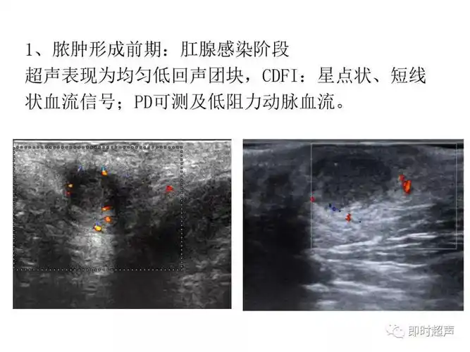 直肠及肛管超声诊断