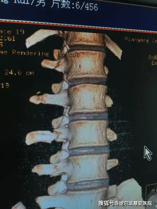 科普第三腰椎横突综合征