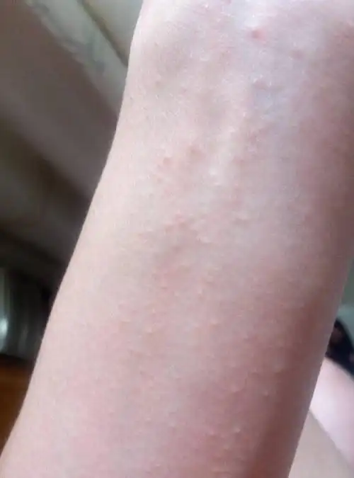 身体起了很多这样的小米状疙瘩,睡前很痒,请问是什么病我好开药,不