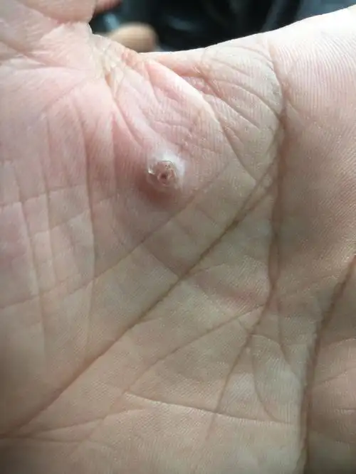 我的手怎么了,医生看下,鸡眼?