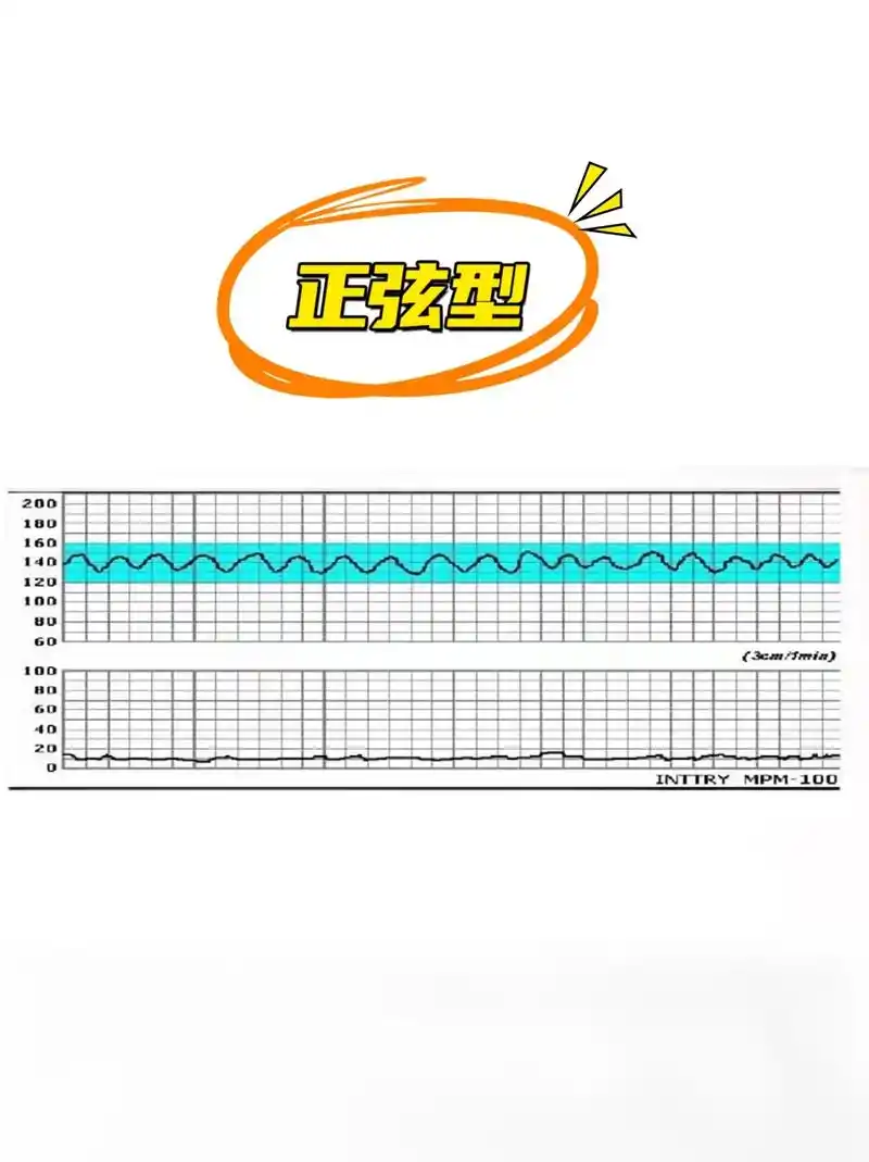 正常胎心监护参照图 - 抖音