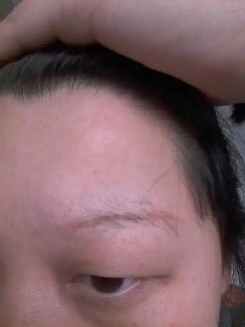 激光洗眉一次现在间隔三个月了有红印可以直接绣眉吗还是要继续洗眉