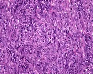 炎性肌纤维母细胞瘤