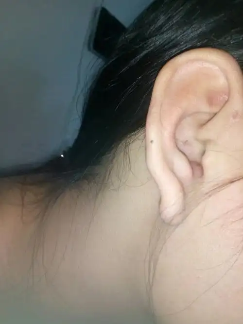 耳朵这里肿起来一个包是怎么回事,挺疼的