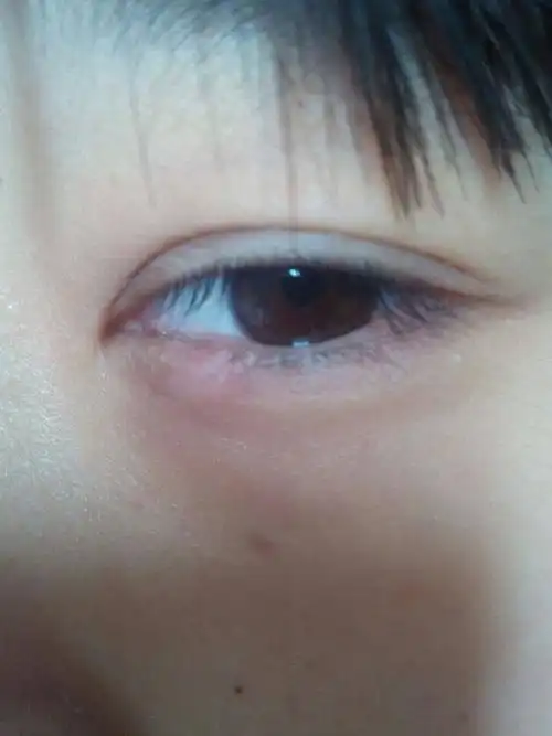 麦粒肿这样能去医院切除了吗?吃药感觉徒劳啊!