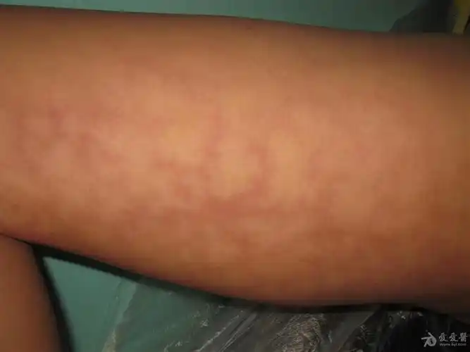 这是什么皮肤病------火激红斑