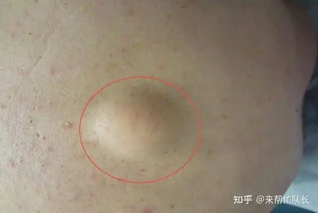 不痛不痒的脂肪瘤如何判断是良性还是恶性要手术吗