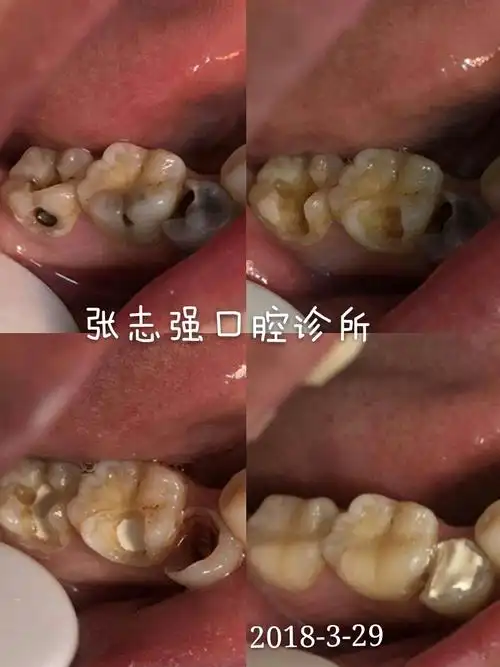 浅龋和中龋 "补牙"即可当蛀牙的病变只是到达牙釉质层或牙本质层时,叫
