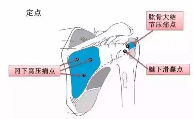 再来看看冈下肌的压痛点;尤其注意冈下窝内,和中医的穴位"天宗"基本