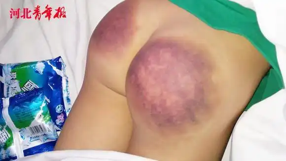 因没有背过乘法口诀 七岁男童遭老师笤帚把抽打 屁