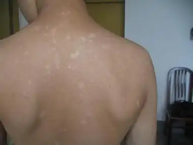 背部白癜风病有哪些症状呢