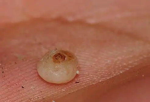 它们会引起一种叫做潜蚤病(tungiasis)的皮肤病.