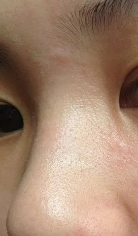 求解~谁能帮我看看鼻子上面长的是不是脂肪粒