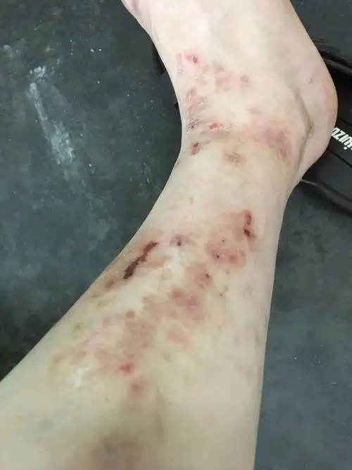 痒,皮肤凸起,痒的抓坏了还有水,像泡一样,究竟是什么病用什么药治