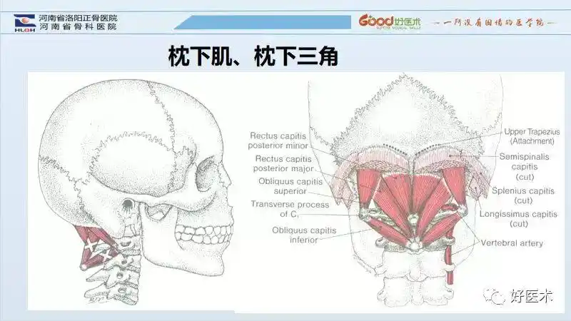 其它 寰枢关节半脱位诊断 写美篇(二)枕下肌,枕下三角   枕下肌群为