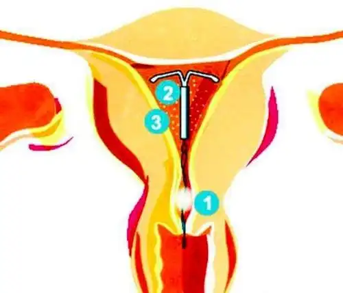 放了节育环,每个月都会提前八九天会有咖啡色分泌物是为什么?