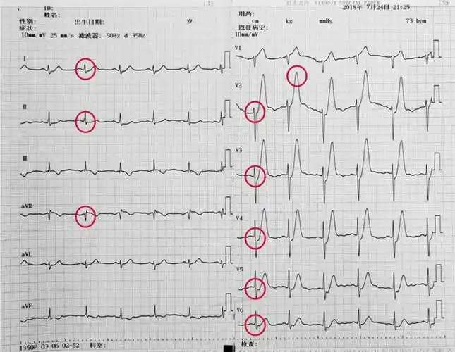occ 2020|心电图|心肌|内膜|冠脉_网易订阅