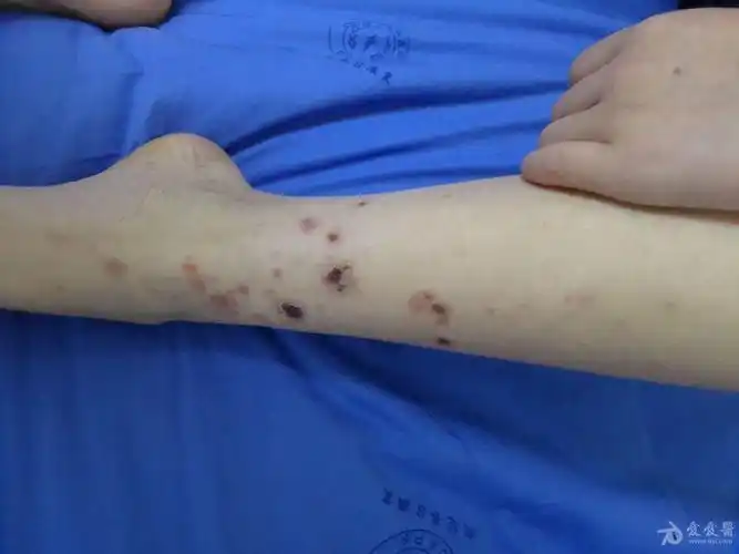 12岁女孩反复双下肢瘀点瘀斑坏死20天初诊考虑过敏性