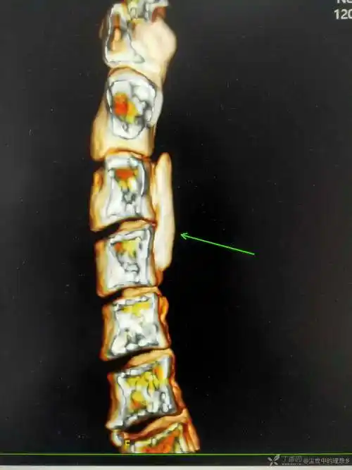 颈椎后纵韧带骨化一例
