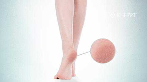 脚底板干裂起硬皮怎么办