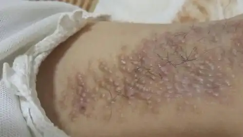 腋下长这种东西,很小就长了,6年级就有了,现在大概快8年了,奇痒无比