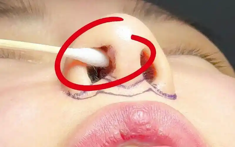 鼻部攻略|隆鼻后鼻孔里长了疙瘩怎么办?