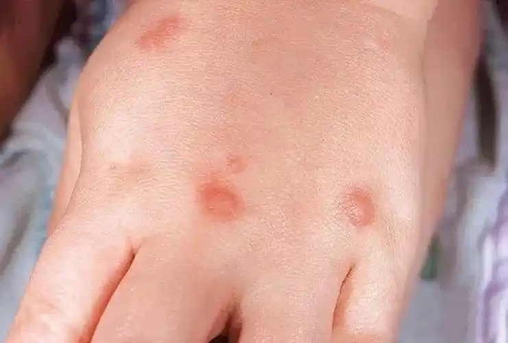 夏天虫咬皮炎扰孩童!_咬螫伤_症状_症状表现 - 好大夫在线