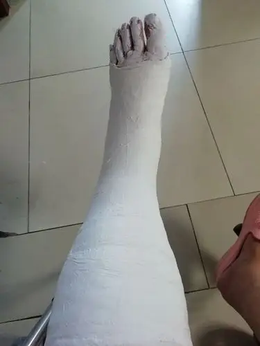 然后又去拍x光片,确诊脚踝骨轻微骨折,打上石膏,又打的回家