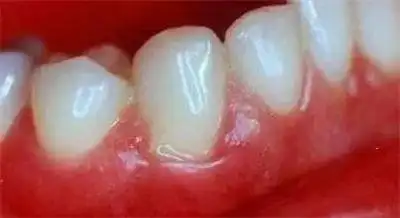 你知道牙周炎有哪些症状吗?