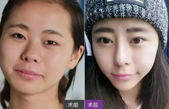 美莱灵动大眼术_开眼角前后对比照片_云南美莱医疗美容医院