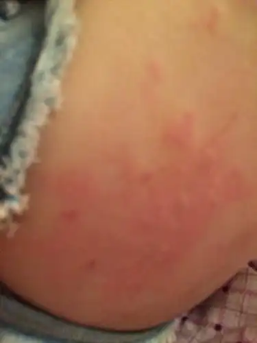 大腿外侧一到晚上就会起红疙瘩 很痒 吃过敏药也没用 如果抓破 抓破