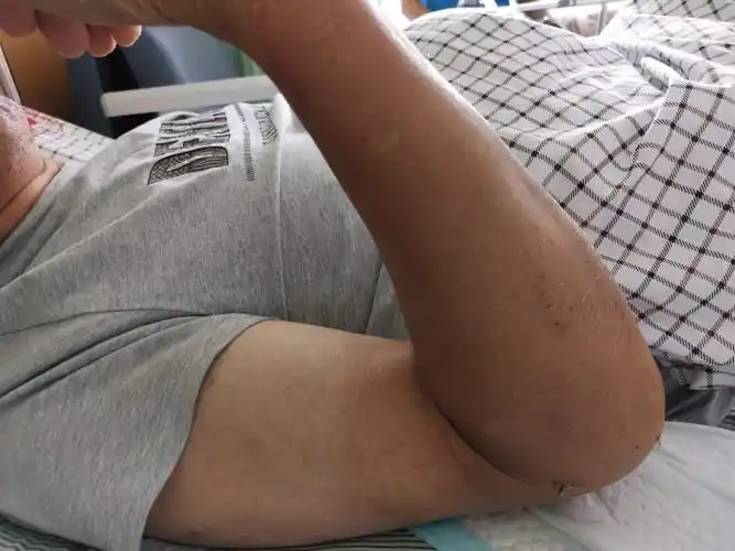 患者术后肘关节屈曲,伸直显著改善,关节活动受限得到了有效的缓解.