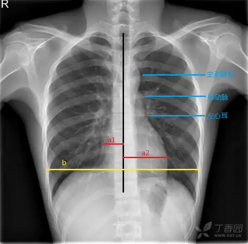 (一)正常胸片中的心脏与大血管 正常胸部解剖结构及后前位胸片如上图