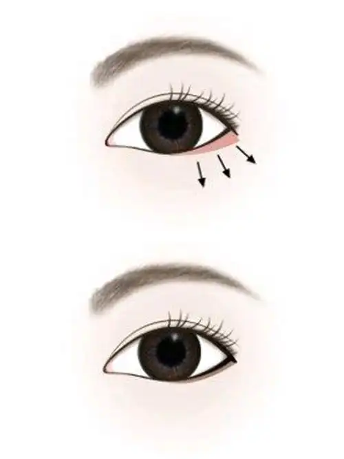 下睑下至手术就是人为地让下眼睑向下退