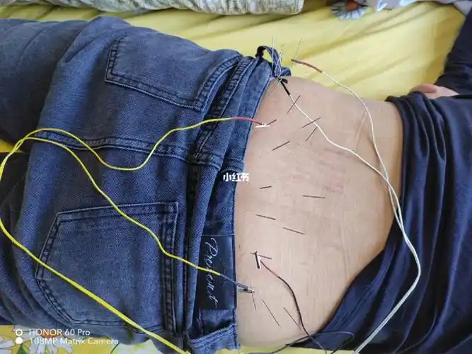 电针灸头一次,做完了松快点,但还是疼#腰椎间盘突出